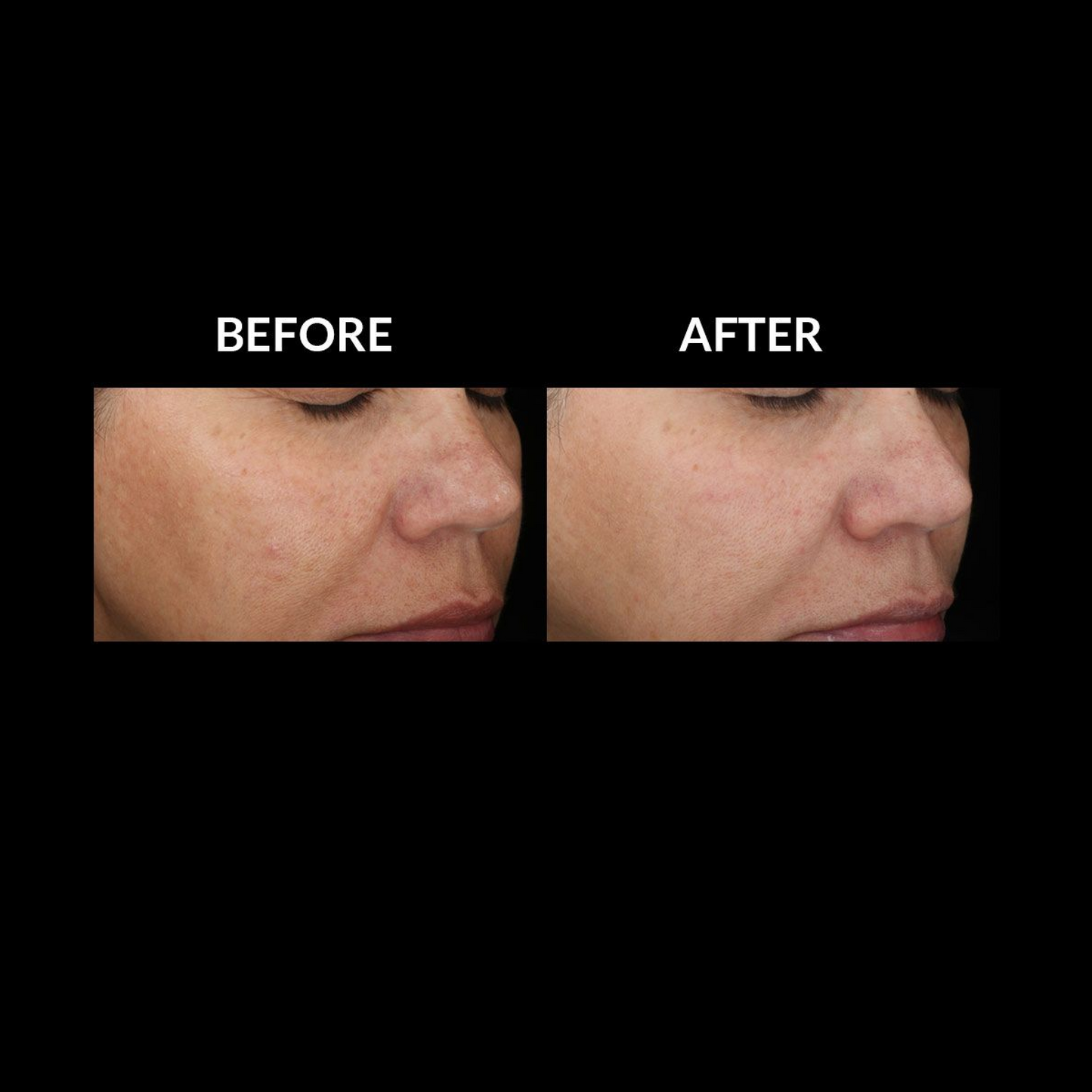 SkinMedica Lytera™ 2.0 Pigment Brightening Serum